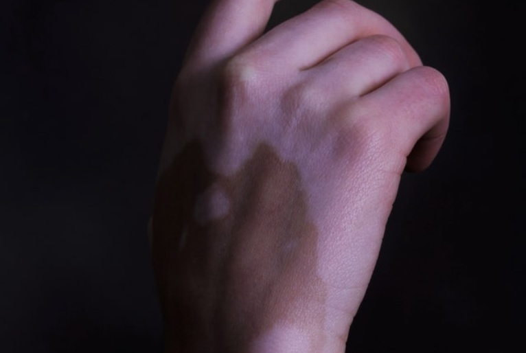Entenda o que é vitiligo, doença que afeta Natália Deodato e 1% da população mundial