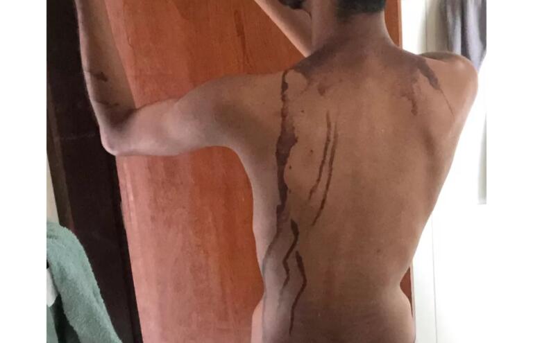 O que se sabe e o que falta esclarecer sobre queimaduras em calouros em trote da UFPR/Palotina