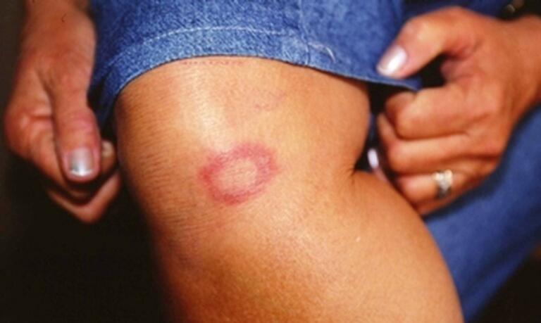 Hanseníase: os preconceitos enfrentados pelos portadores da doença