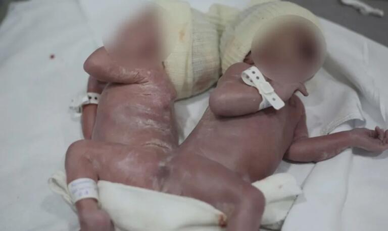 Gêmeos nascem unidos por osso da coluna no Paraná; caso é considerado raro, informa médica