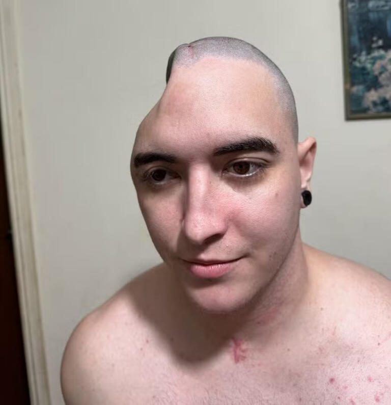 Jovem de Toledo viraliza ao contar que ficou meses com parte do crânio ‘guardada’ na barriga após acidente