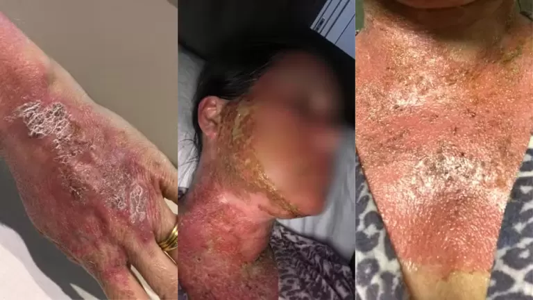 Farmacêutico e clínica que causaram queimaduras em mulher após peeling são condenados a pagar R$ 125 mil de indenização